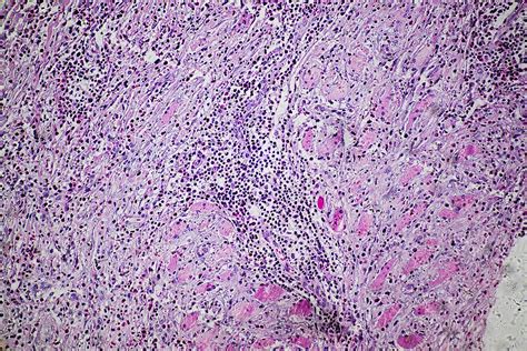 Eosinophilic Granuloma