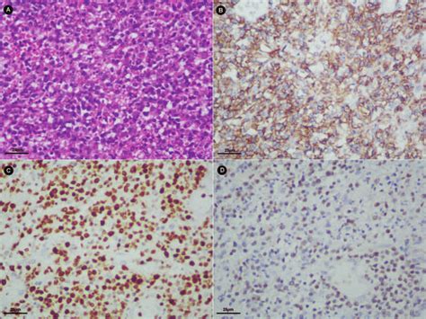 Histologic findings of the lymphoma tissue under the microscope. (A ...