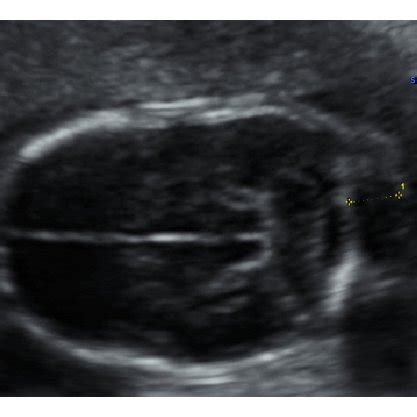 Increased nuchal fold in a transverse view (a) and in a longitudinal... | Download Scientific ...