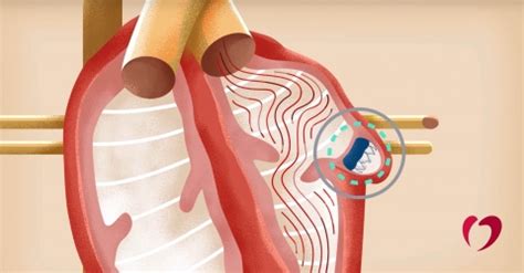 The Watchman Device for Atrial Fibrillation | Oklahoma Heart Hospital