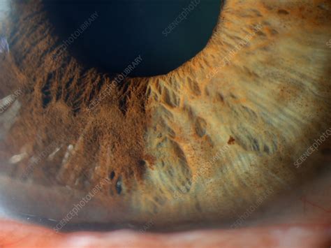 Iris Nevus - Stock Image - C027/2023 - Science Photo Library