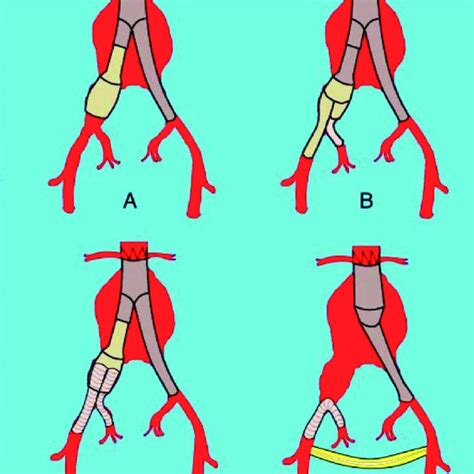 Angiogram showing the aneurysm and internal iliac artery branches. | Download Scientific Diagram