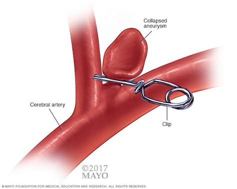 Brain aneurysm - Diagnosis and treatment - Mayo Clinic