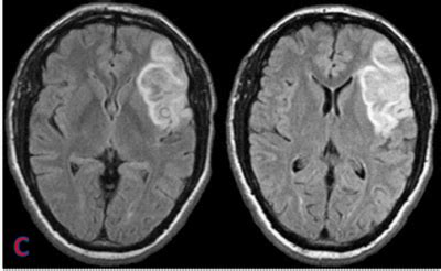 Can an MRI Miss a Stroke? MRI vs. CT Scan for Stroke Detection » Scary Symptoms