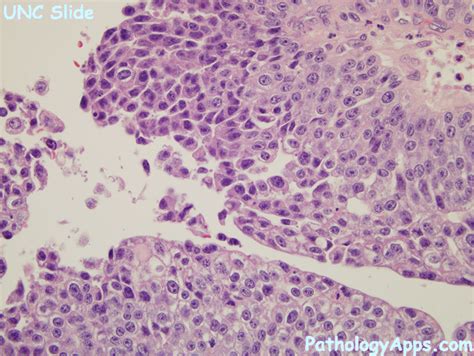 urothelial carcinoma pathology