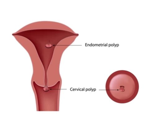 Effects of Endometrial polyps on fertility