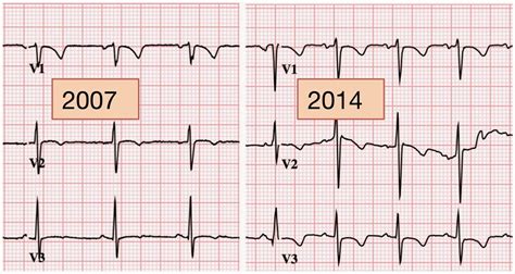 Dr. Smith's ECG Blog: Persistent Juvenile T-wave Pattern