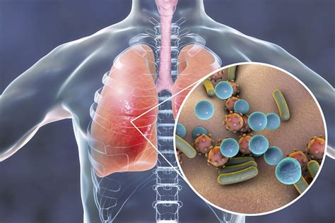 Evaluasi Kuantitatif Penggunaan Antibiotika pada Pasien Pneumonia-ICU ...