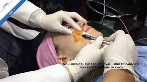 Non-Surgical Eye bag Removal by Dr Han-Jin Kwon - Part 1: Radio Frequency (RF) Cannula - YouTube