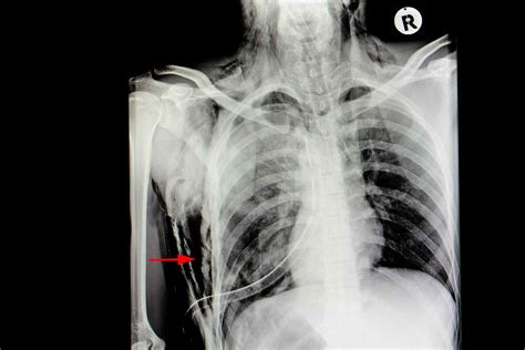 Subcutaneous Emphysema: Symptoms, Causes, and Treatment