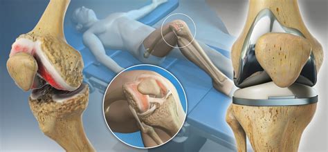 Computer-Assisted Knee Replacement - East Coast Orthopaedics