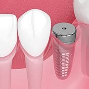 Dental Implants Pepper Pike, OH | Missing Teeth | Dentures