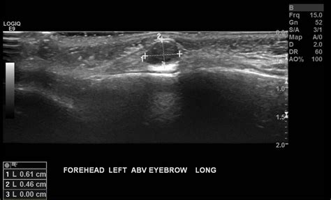 Subcutaneous Dermoid Cyst Ultrasound