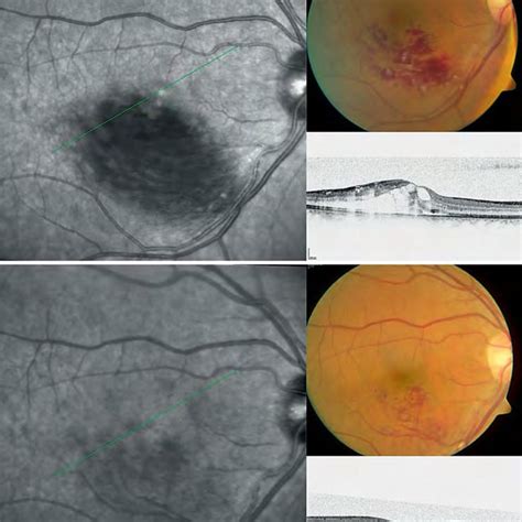 Spectralis OCT of a DME patient before anti-VEGF treatment (courtesy of... | Download Scientific ...