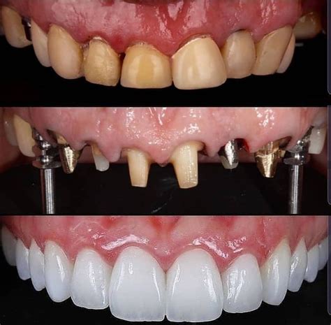 Pin on Fixed prosthodontics