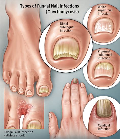 Fungal Nail Infection | Dermatology | JAMA | The JAMA Network