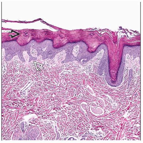 Ichthyosis Vulgaris Histology