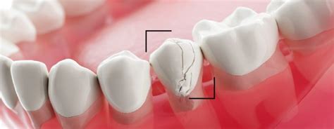 Dental crown repair procedure and cost - Dentakay