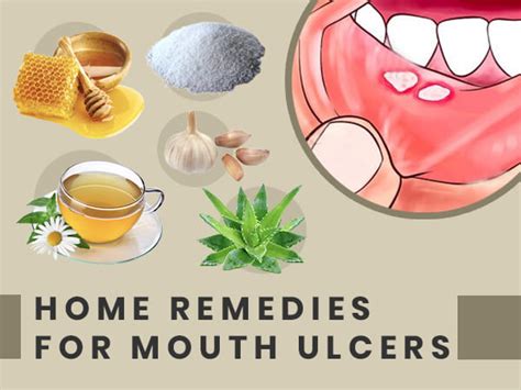 Unique Info About How To Cure An Ulcer In The Mouth - Petertrade29