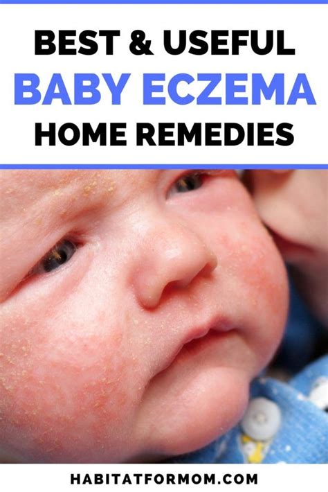 Best Remedies for Baby Eczema (ultimate list) | Baby eczema remedies ...