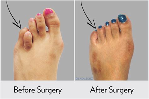 Cosmetic Toe Lengthening: Brachymetatarsia Surgery | HuffPost Life