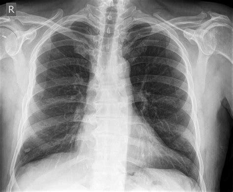 Pulmonary Nodules and Masses | Chest X-Ray - MedSchool