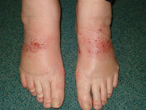 dermatitis feet - pictures, photos