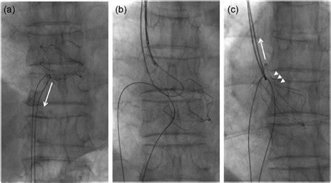 (a) The inferior vena cava filter in the right ventricle was pulled... | Download Scientific Diagram