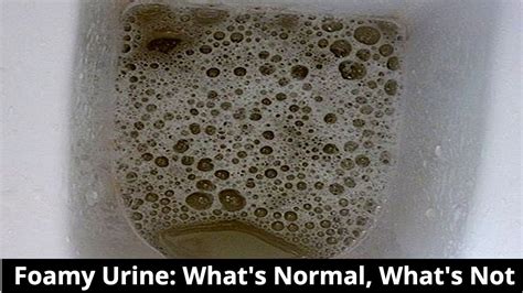 Foamy Urine: What's Normal, What's Not || Foamy Urine Causes, Symptoms A... | Urinal, Symptoms ...