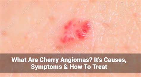 What Are Cherry Angiomas? It’s Causes, Symptoms & How To Treat | Eczemaless