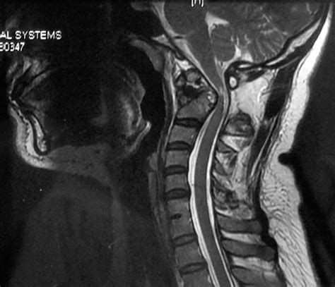 Atlanto-occipital Dislocation - Causes, Symptoms, Treatment - Rxharun