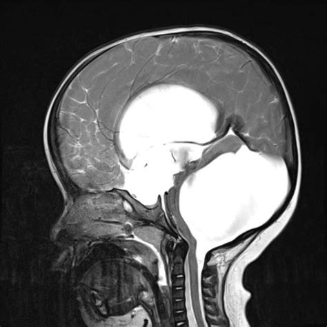 Dandy Walker malformation | Radiology Case | Radiopaedia.org | Radiology, Radiology imaging ...