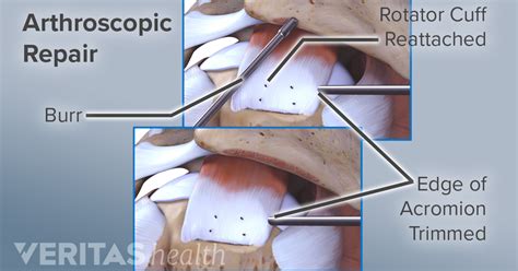 Rotator Cuff Repair Surgery