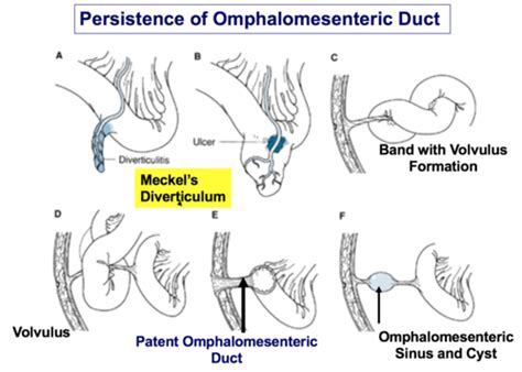 Omphalomesenteric Duct