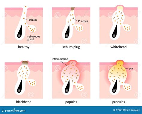 Acne Formation. Papule And Pimple Vector Illustration | CartoonDealer ...