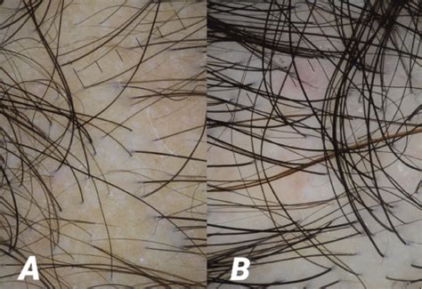 A Case of Hair Regrowth in a Patient with Complete Androgen Insensitivity Syndrome and Female ...
