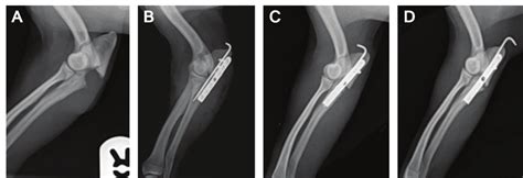 Radiographs of the right ulnar trochlear notch fracture. A-before the... | Download Scientific ...