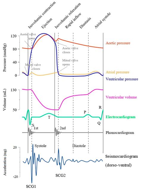 Wiggers Diagram Aortic Regurgitation