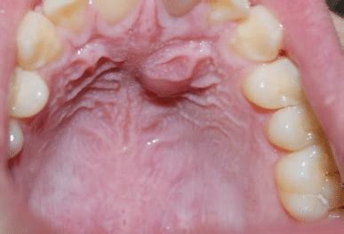 Bump on Roof of Mouth, Painful, Hard, White, Red, Small, Causes, How to Get Rid of It and ...