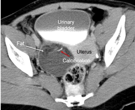 Mature cystic ovarian teratoma – Radiology Cases