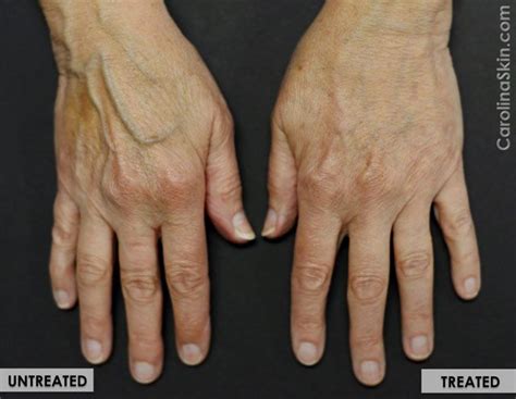 Hand Vein Treatments | Dermatology, Laser & Vein Specialists of the ...