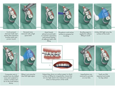 Composite Cavity Filling on Behance