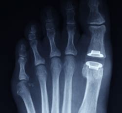 Hallux Rigidus Surgery – FeetFixer