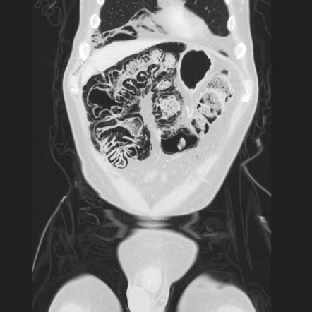 Pneumatosis coli, graft versus host disease, acute aortic thrombus | Radiology Case ...