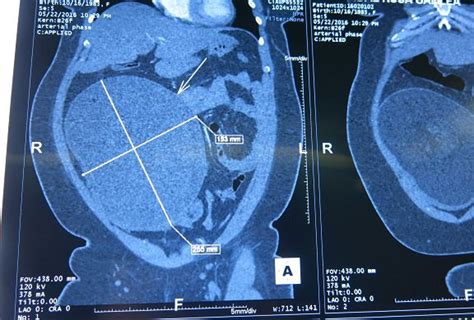 Successful surgical removal of ovarian tumor of more than 7kg | Vinmec