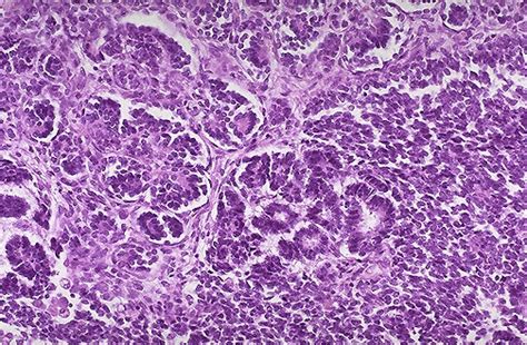 Renal Pathology