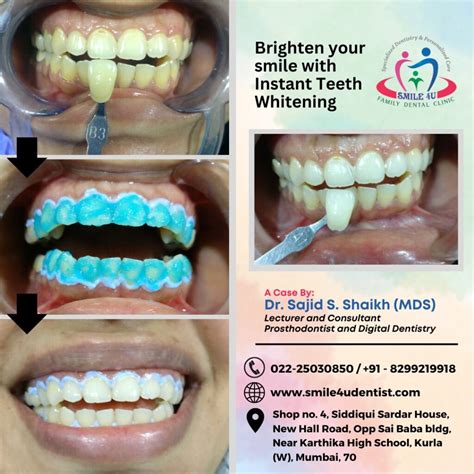 teeth whitening service in Kurla, teeth whitening service in Mumbai