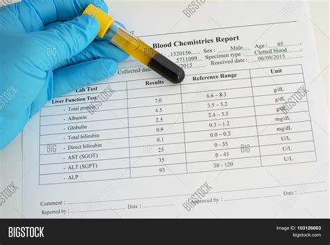 Liver Function Test Results