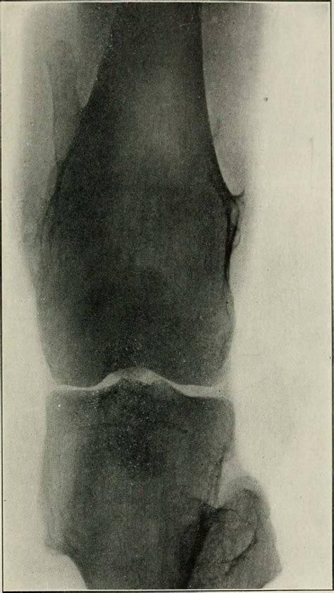 Tuberous sclerosis treatment | General center | SteadyHealth.com