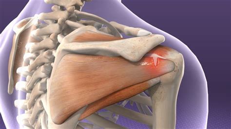 Rotatorcuffruptur – Kraftsportkliniken